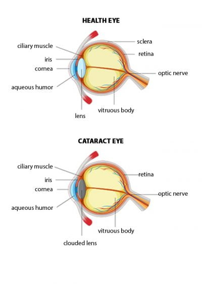 Cataract