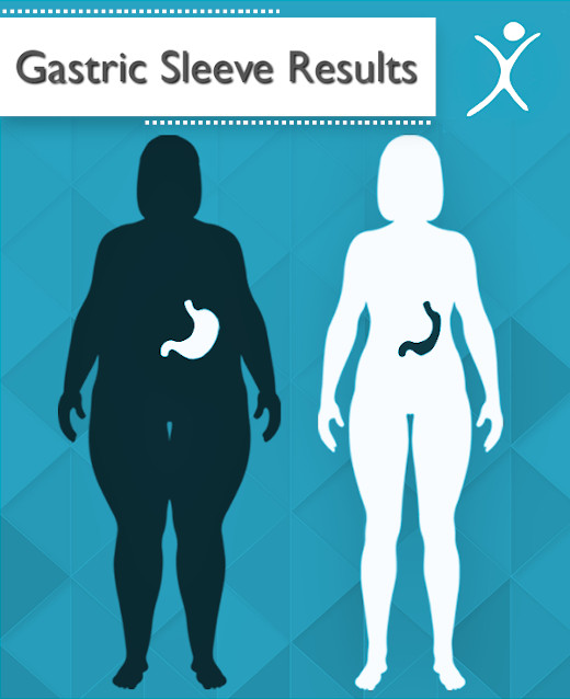 Gastric-Sleeve-Surgery-Results-Mexico-Bariatric-Centerq