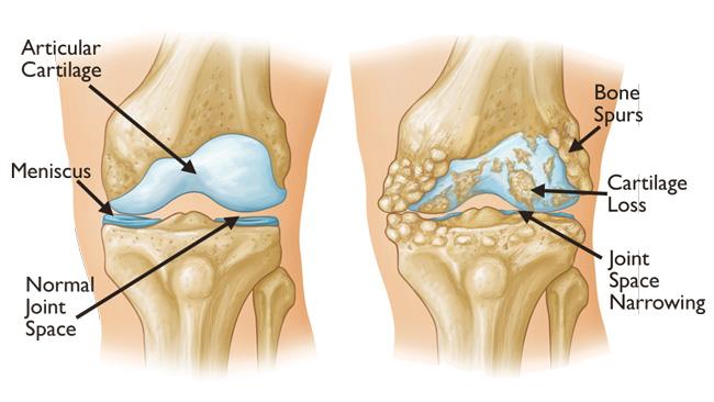 Knee Replacement