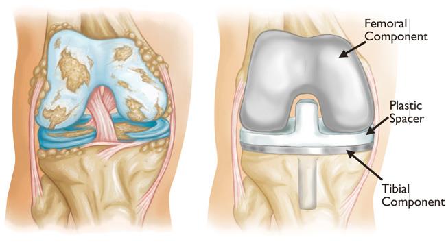 Knee Replacement