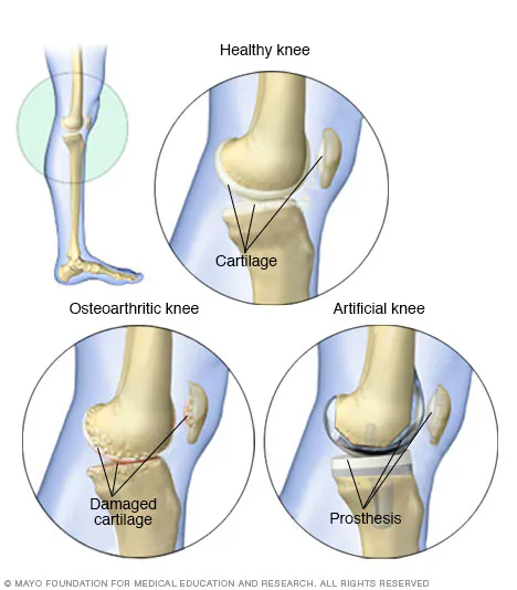 robotic-hip-replacement-turkey-1