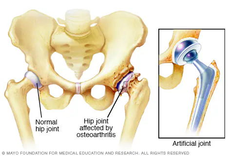 robotic-hip-replacement-turkey